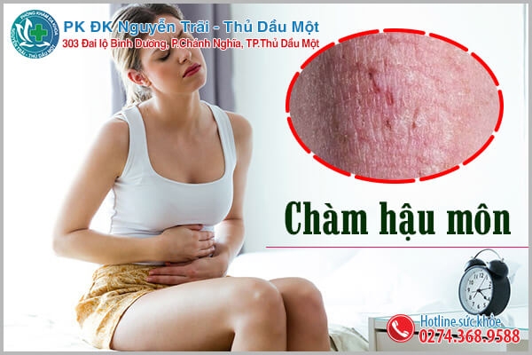 Chàm hậu môn là gì?