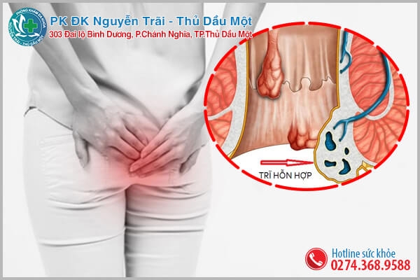 Bệnh trĩ hỗn hợp là gì?